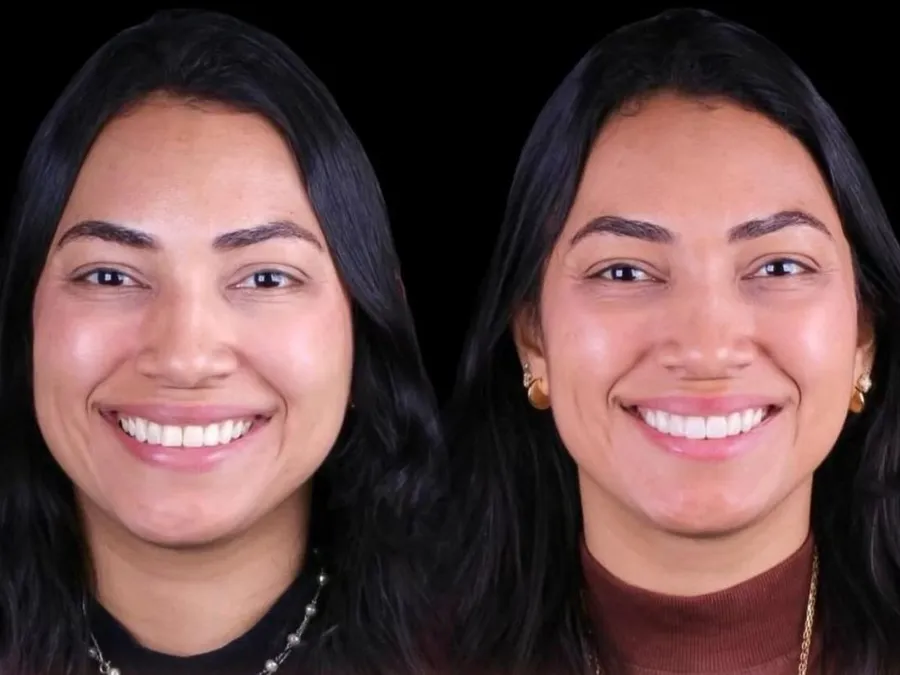 Revittale — Antes e depois — facetas